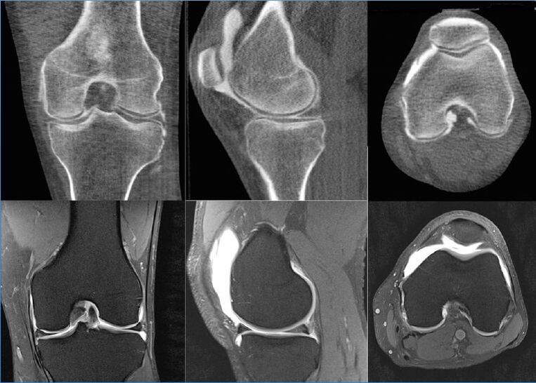 osteoartrita deformatoare a articulației genunchiului stâng)